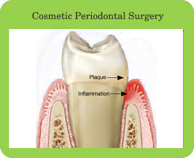 Cosmetic Periodontal Surgery, Houston, TX