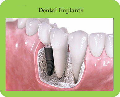 Dental Implants, Houston, TX